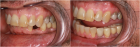 Affordable Dental Implants in Columbus | Dublin Metro Dental