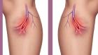 Can You Die from a Burst Varicose Vein: Myths vs. Facts?