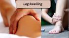 Does leg swelling affect circulation?