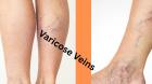 How to Determine If Your Varicose Veins Are Genetic?