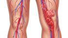 Innovative Treatments for Varicose Veins and Blood Clot Prevention