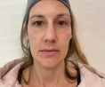Rejuvenate Your Skin with Radio Frequency Microneedling in Colorado Springs