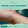 Spider Vein Treatment
