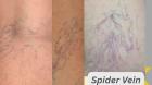 Transform Your Skin: Benefits of Laser Spider Vein Removal