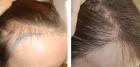 Scalp Tattoo Near Me: Conceal Your Hair Loss