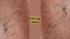 Why are my veins so dark all of a sudden?