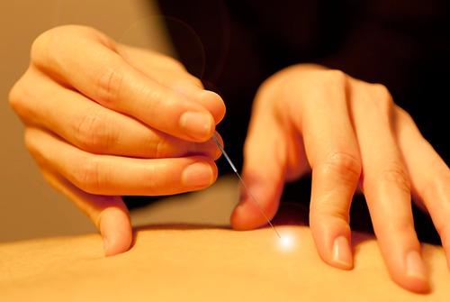 Acupuncture NYC