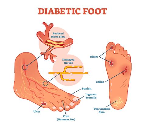 Advanced Diabetic Wound Care NYC - Oleg Karpenko Podiatry PC