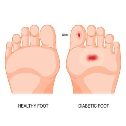 Advanced Diabetic Wound Care NYC - Oleg Karpenko Podiatry PC