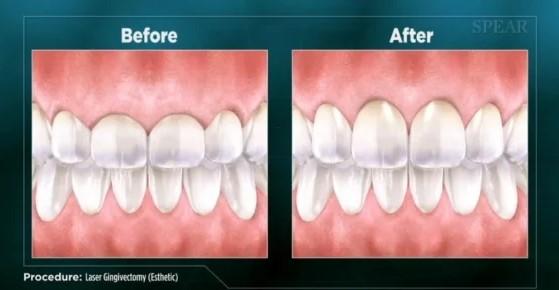 Get a Perfect Smile with Same-Day Crowns in Las Vegas!