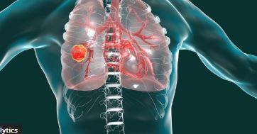 Lung Cancer, Third Most Common Cancer in the U.S