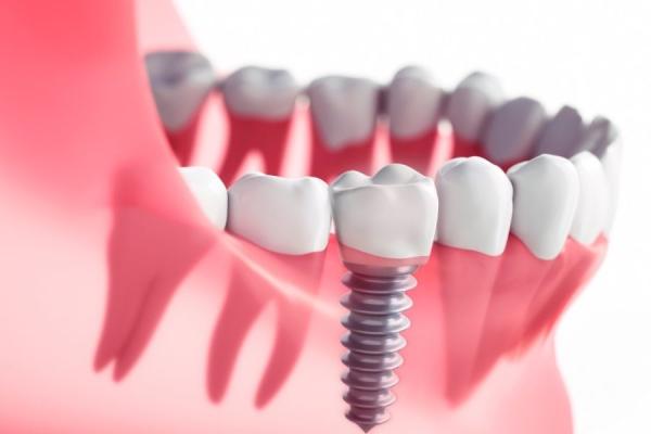 Restore Your Smile with Dental Implants in Boronia