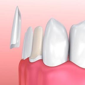 Dental Implants Maromoneck