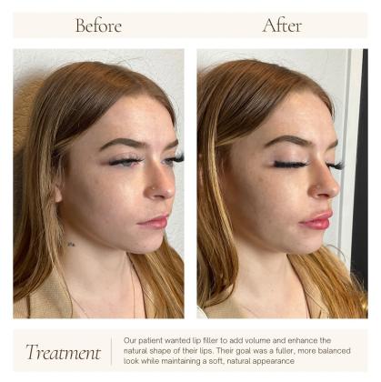 Face Filler vs Body Filler: Understanding the Difference and Choosing the Right One for You!