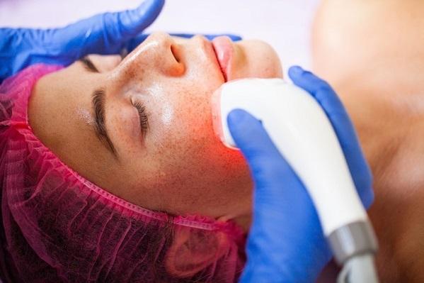 Laser For Rosacea Treatment Orlando