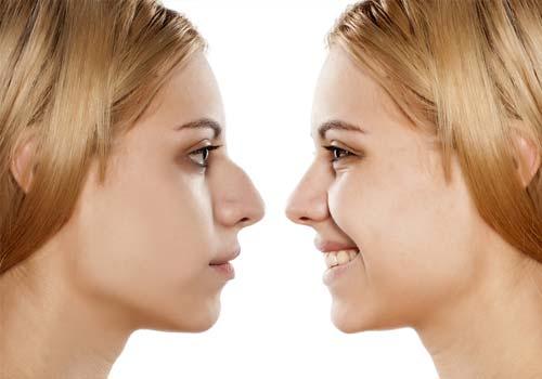 rhinoplasty surgery in punjab