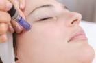 Microneedling for Stretch Marks Near Me – Trusted Care at Enora Wellness