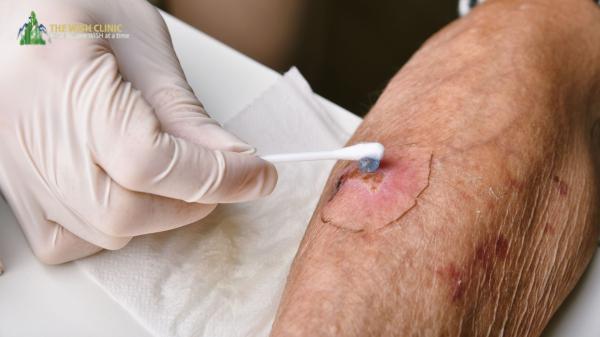 Diabetic Wound Healing