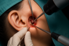 chronic suppurative otitis media surgery